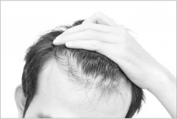hair transplant clinic indore, best hair transplant clinic in indore