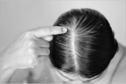 Female Hair Transplant, hair loss treatment in indore, hair dr indore
