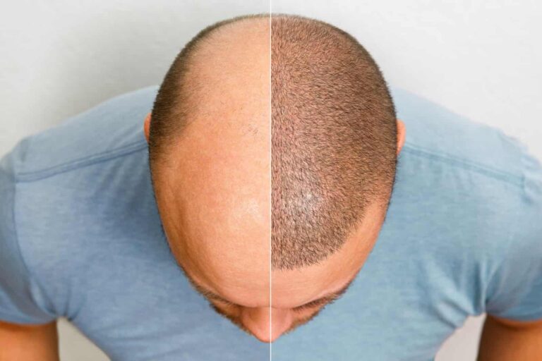 hair transplant centre in indore, hair transplant doctor in indore