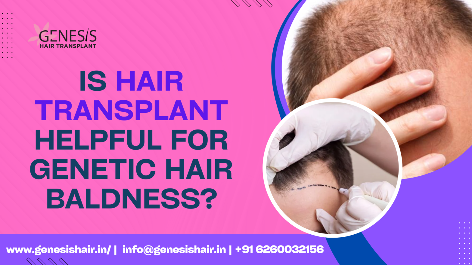 Is Hair Transplant Helpful for Genetic Hair Baldness?