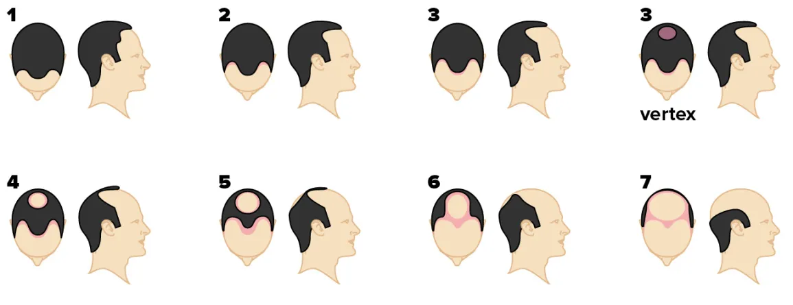 Grades of hair loss